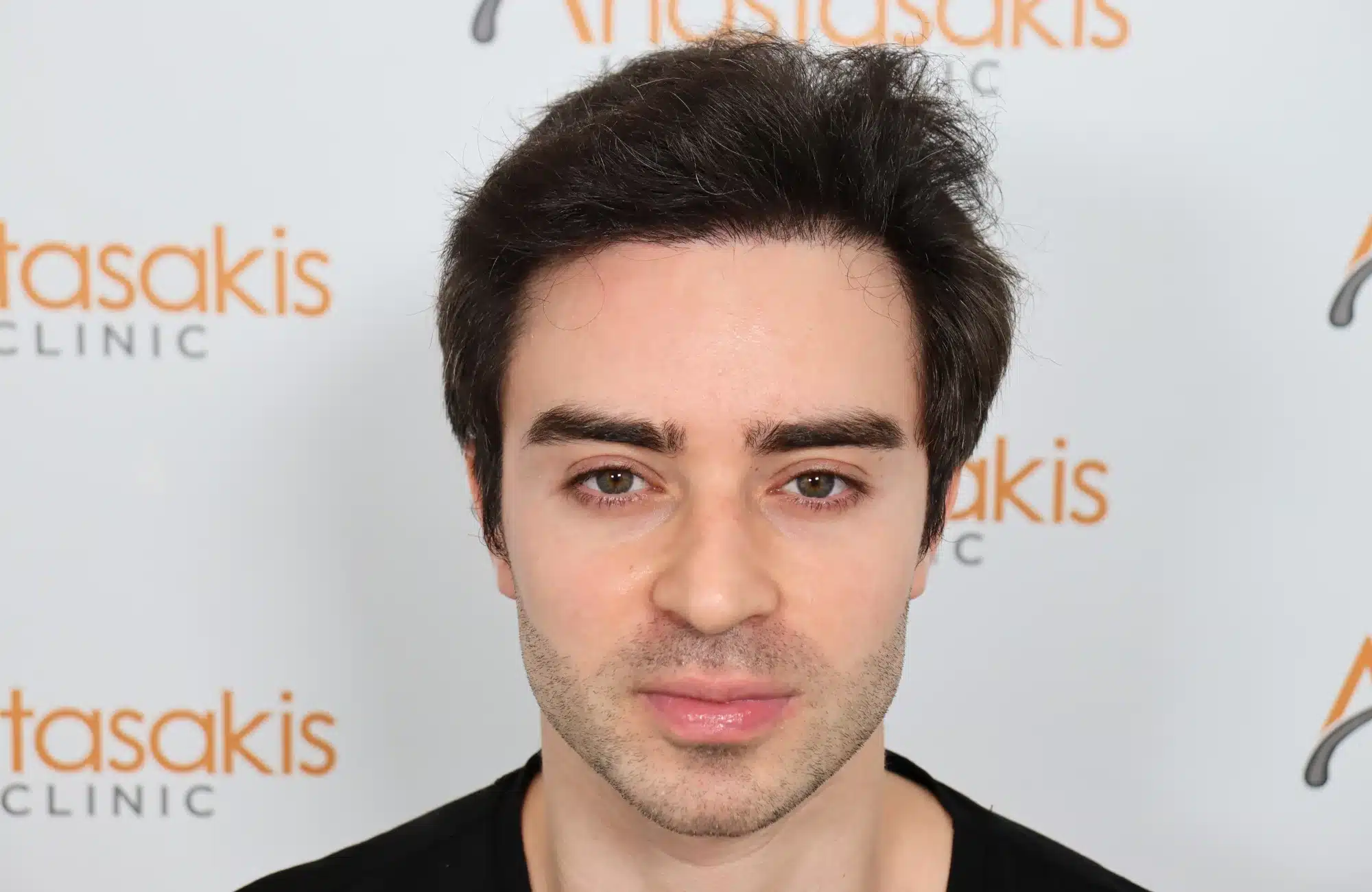 hair transplant 2600 fus