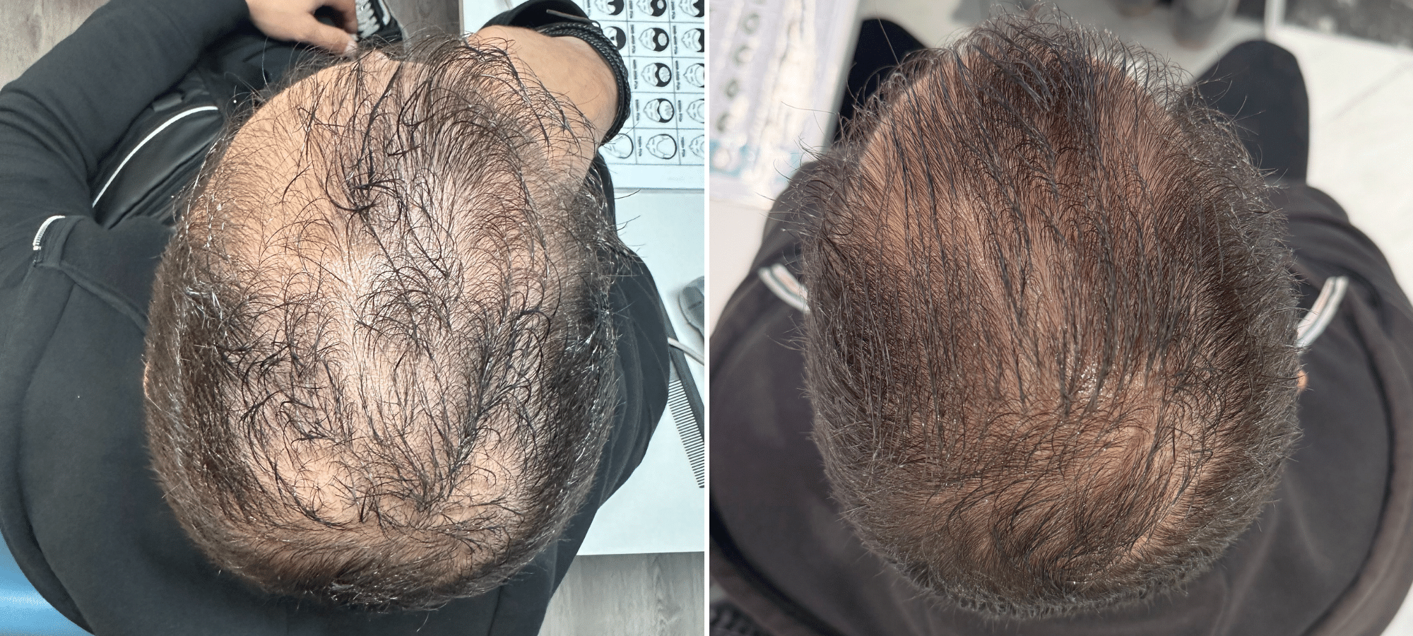 Dr. Anastasakis Hair Clinic