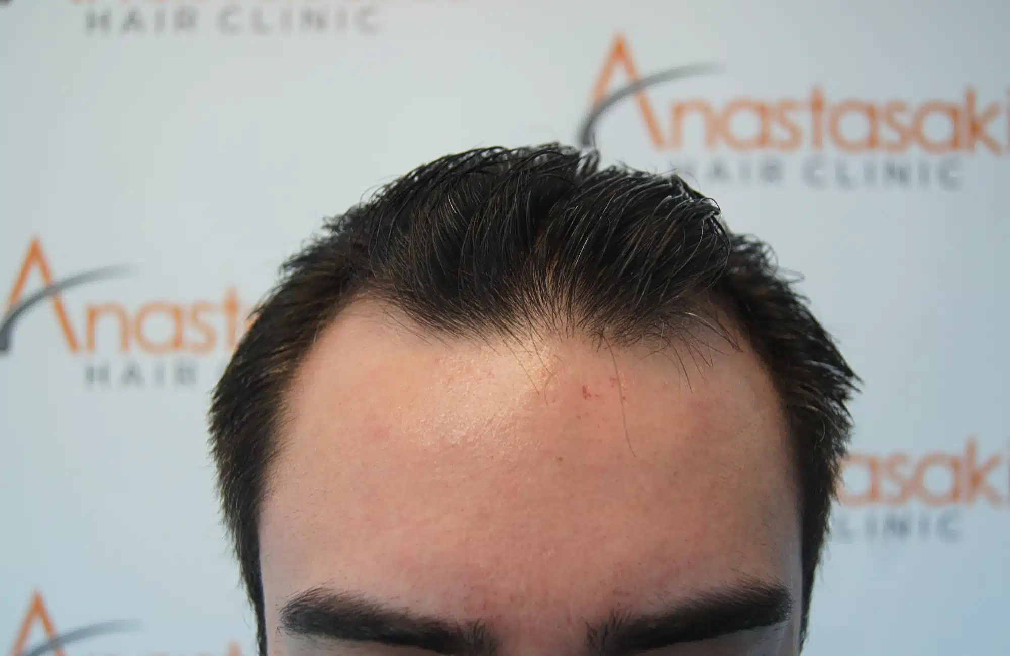 hair transplant 2600 fus