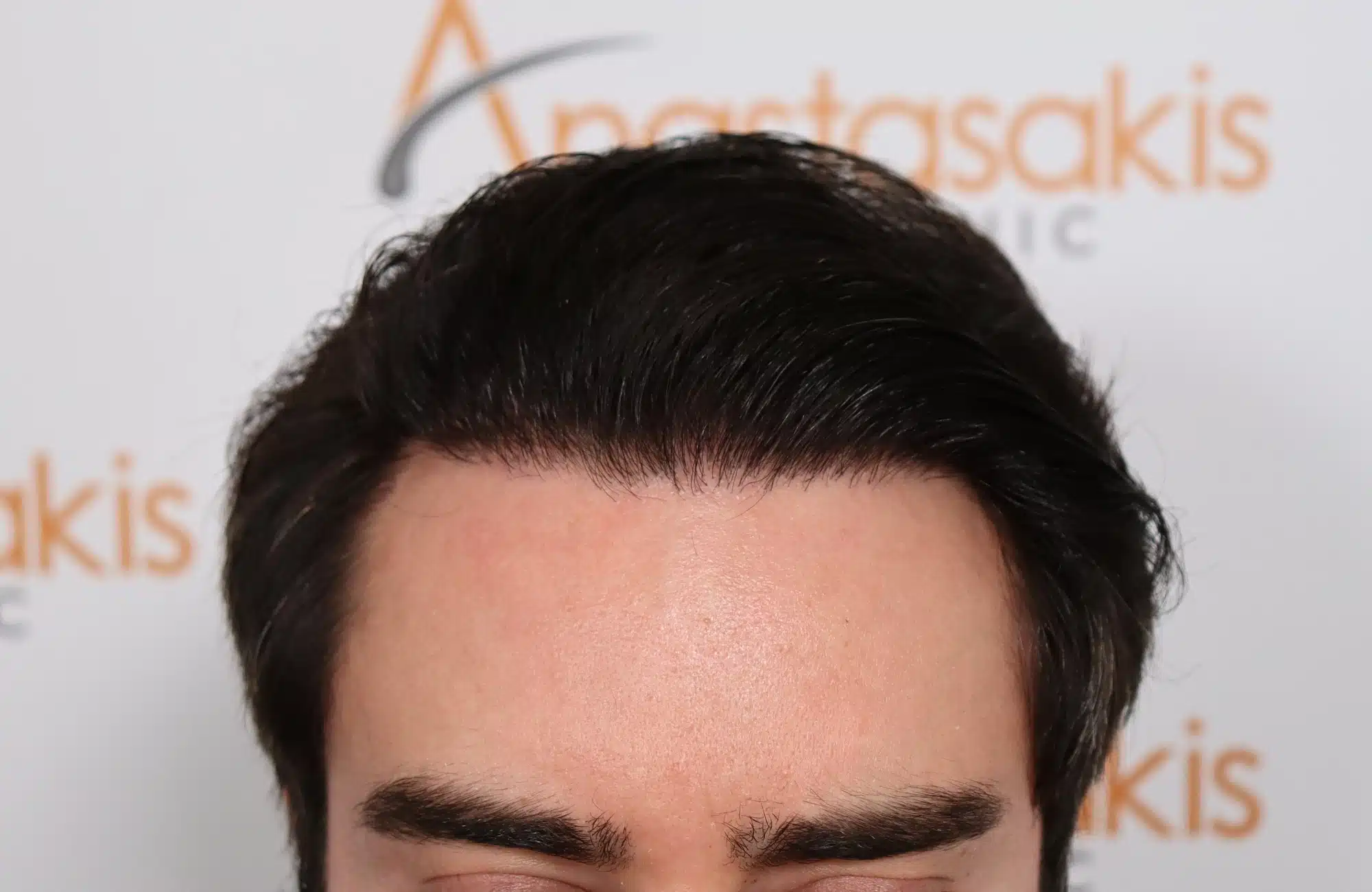 hair transplant 2600 fus