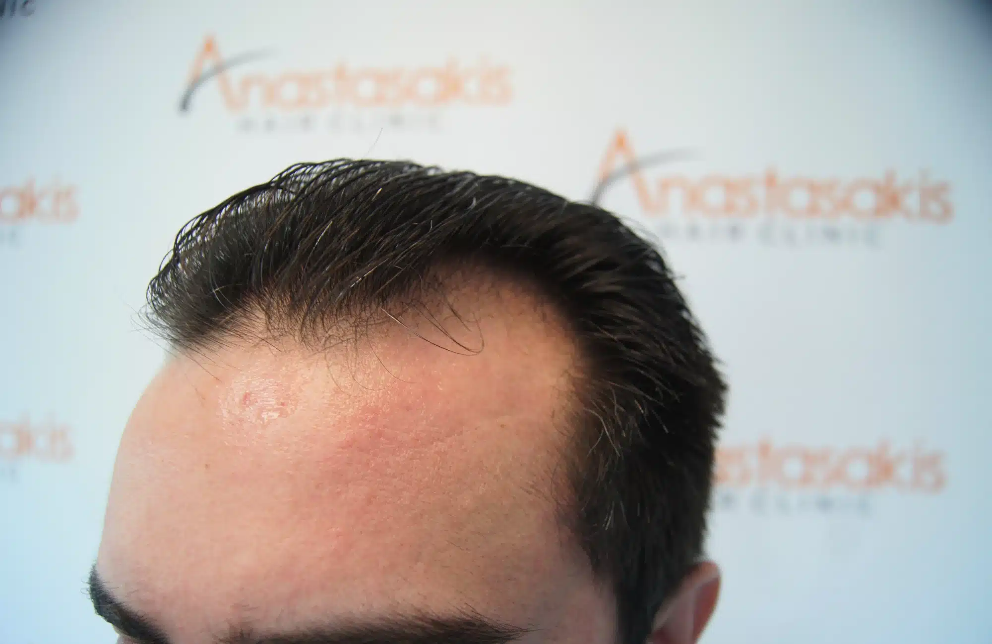 hair transplant 2600 fus