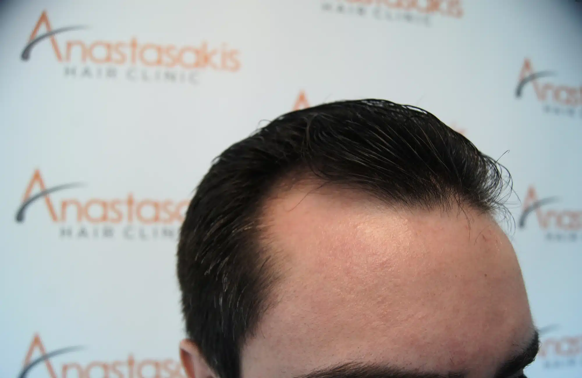 hair transplant 2600 fus