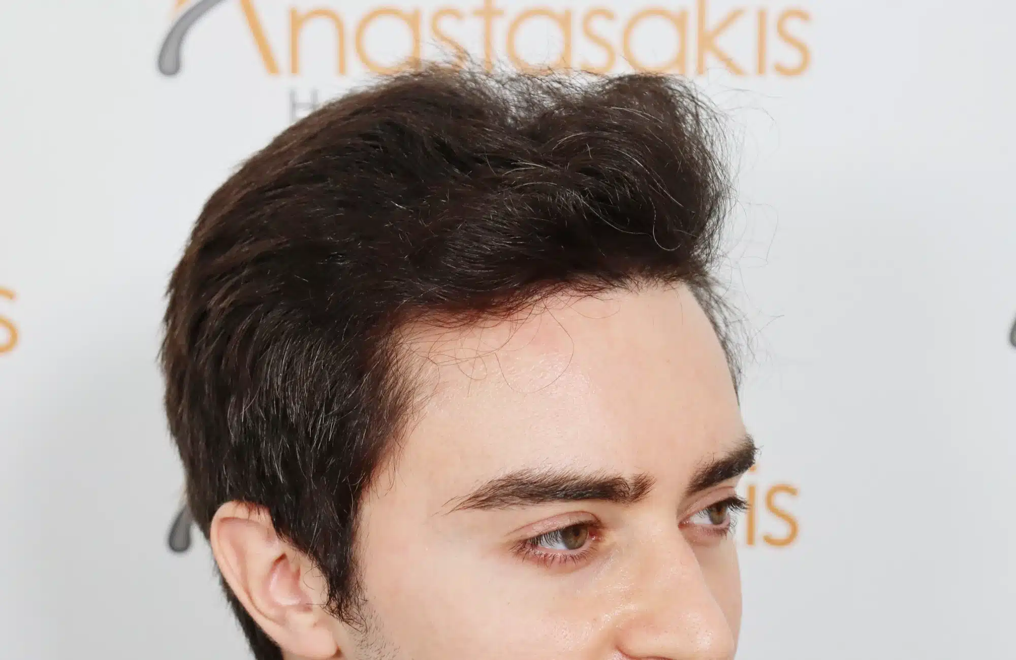 hair transplant 2600 fus