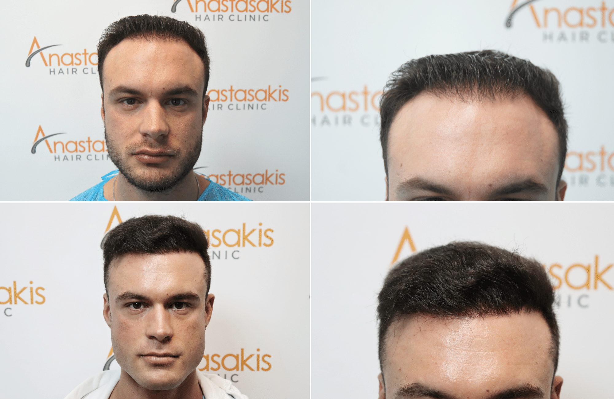 hair transplant result