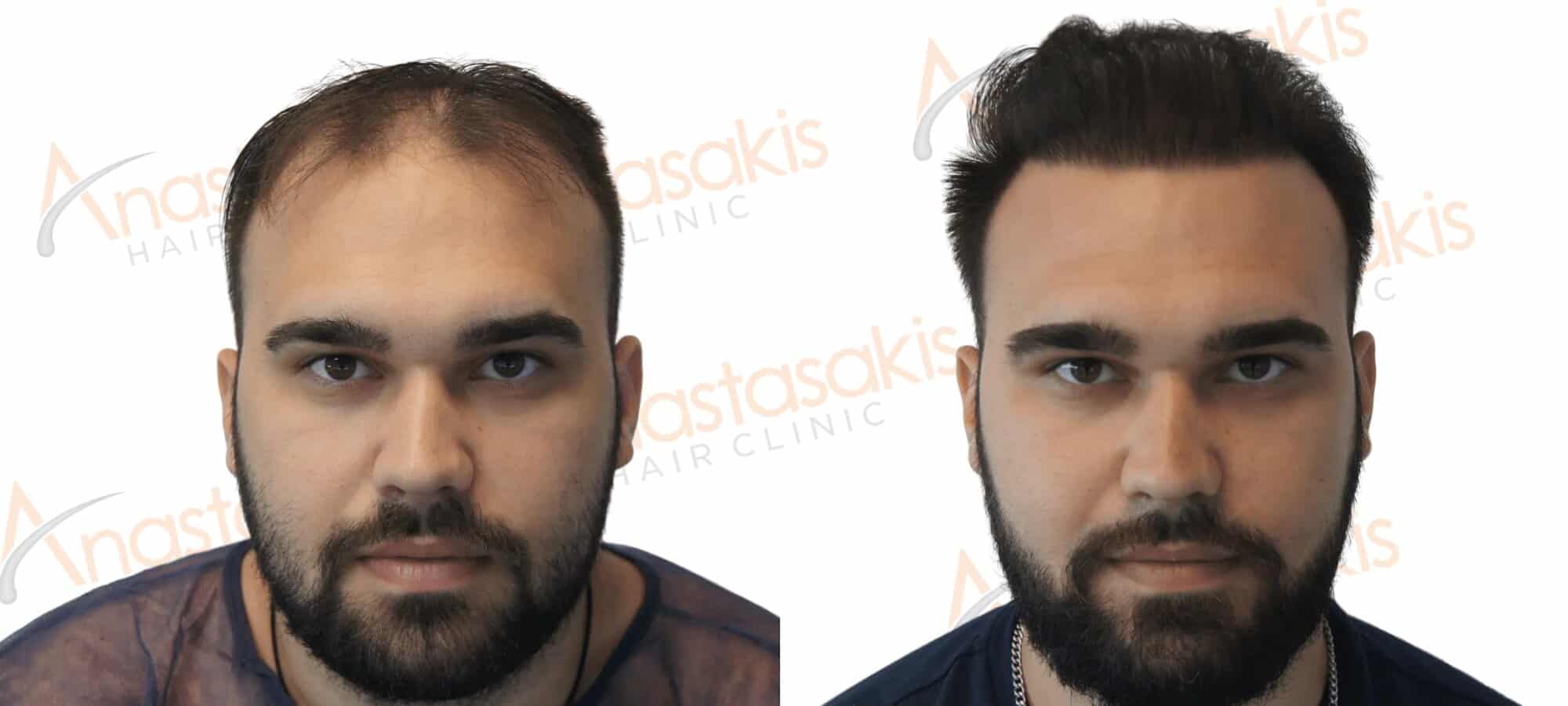 Anastasakis Hair Clinic