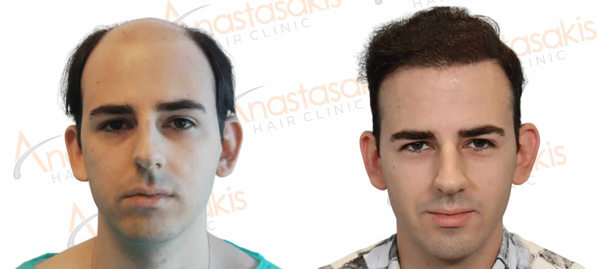 Anastasakis Hair Clinic