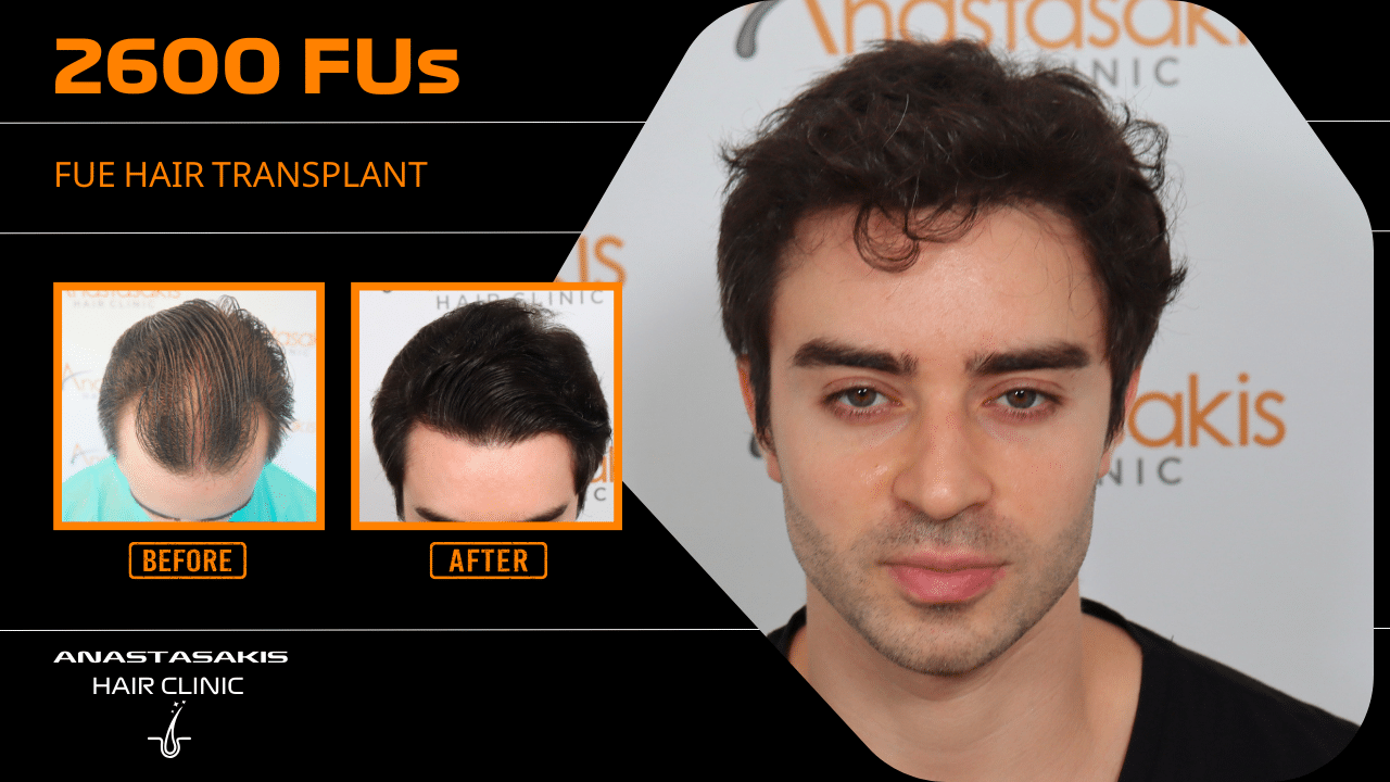 hair transplant 2600 fus