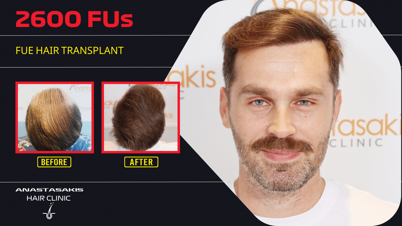hair transplant 2600 fus