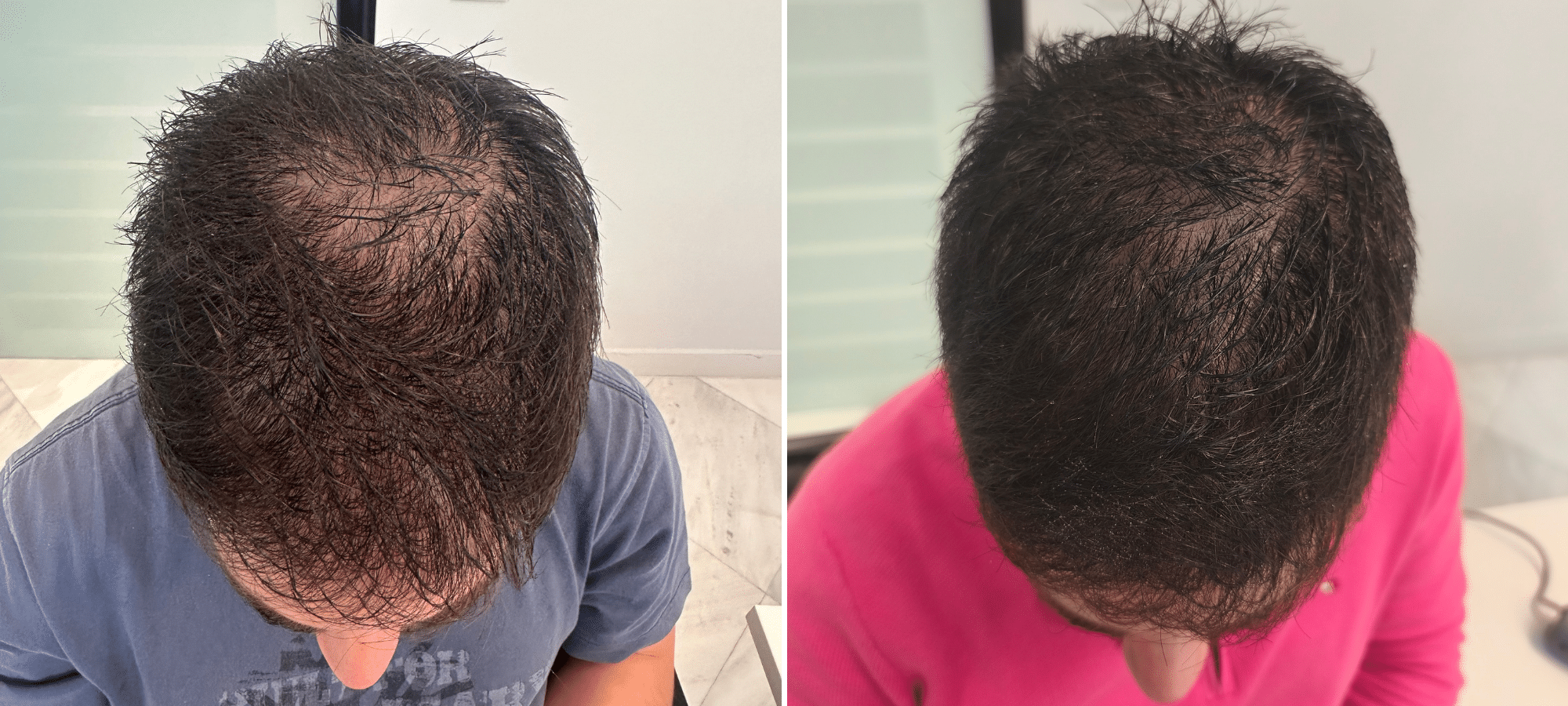 Dr. Anastasakis Hair Clinic
