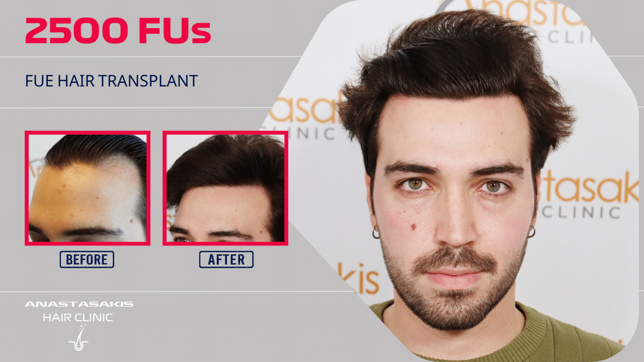 hair transplant result 2500 fus anastasakis hair cliniic