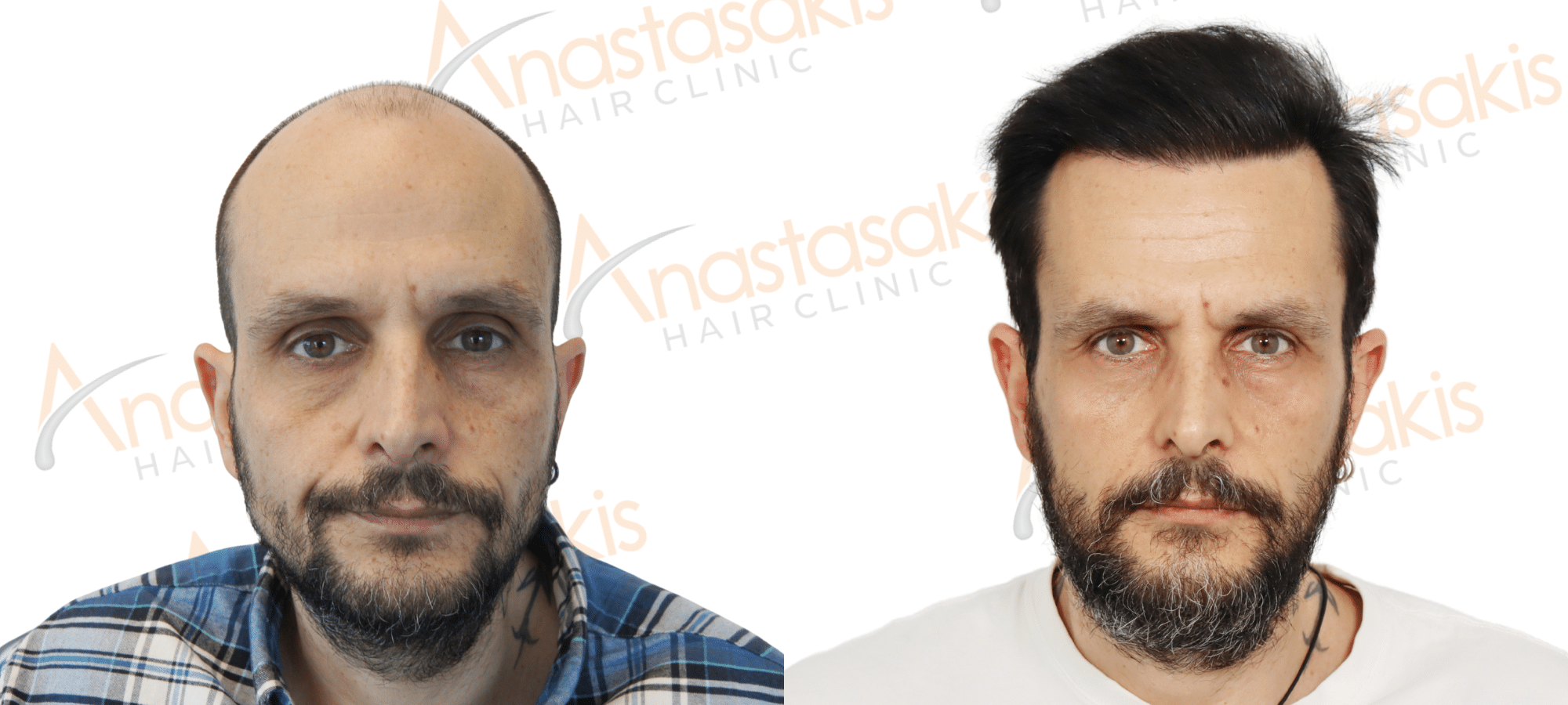 hair transplant result with 4800 fus in 24 months 2nd stage