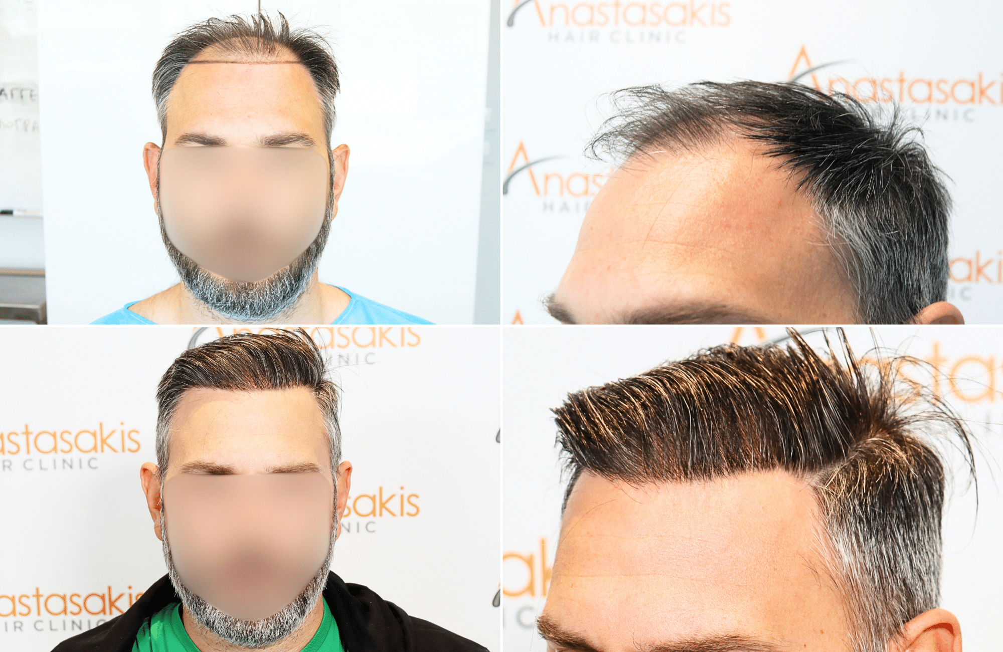 https://www.anastasakishairclinic.gr/portfolio/apotelesma-metamosxefsis-mallion-anastasakis-hair-clinic-209/