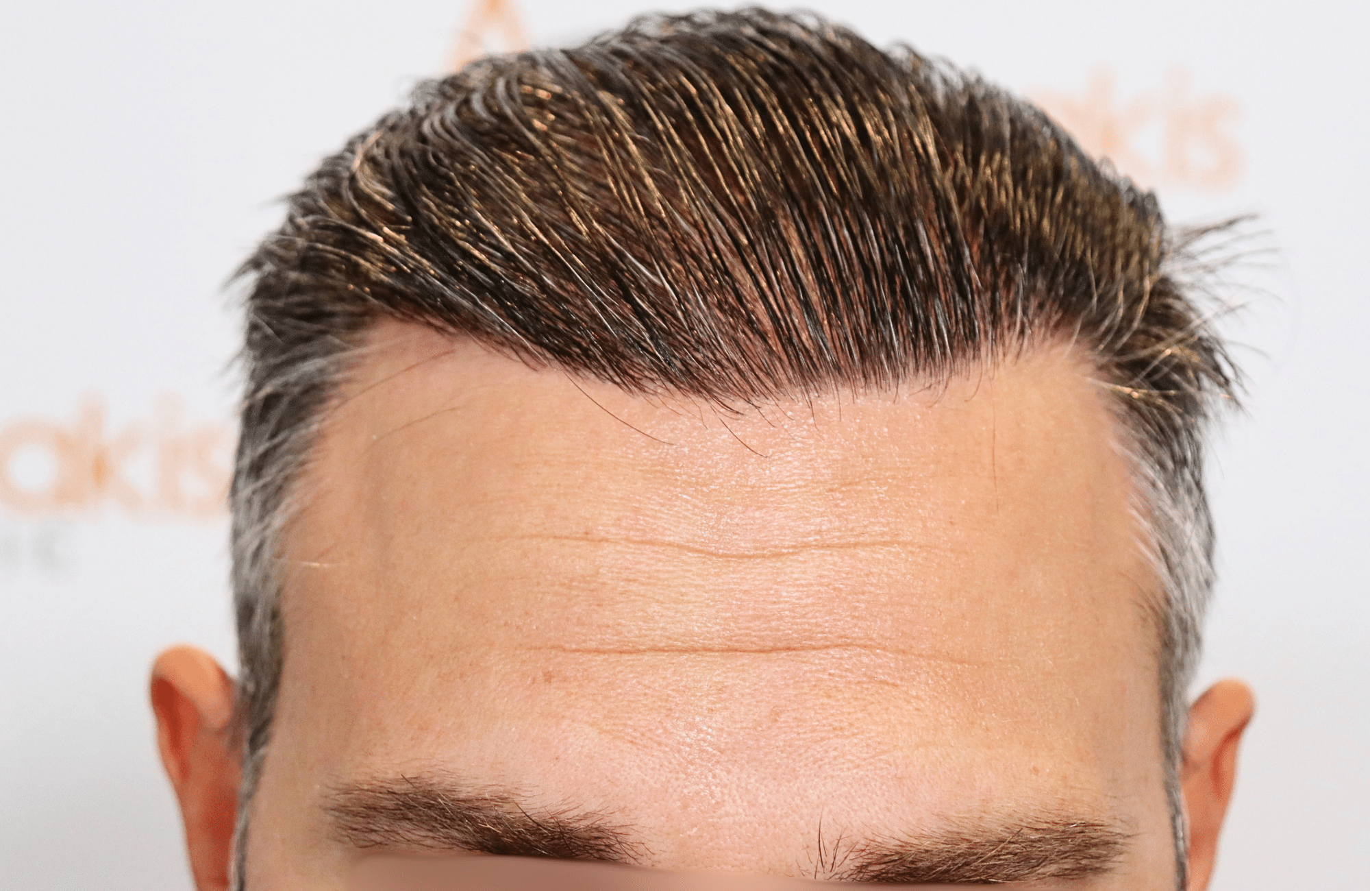 hair transplant result 3500 fus thick 1st stage