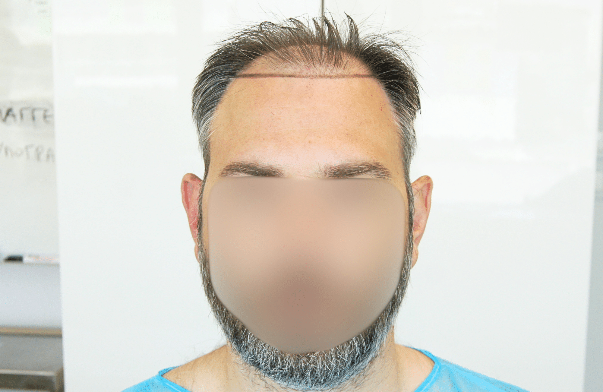 hair transplant result 3500 fus thick 1st stage