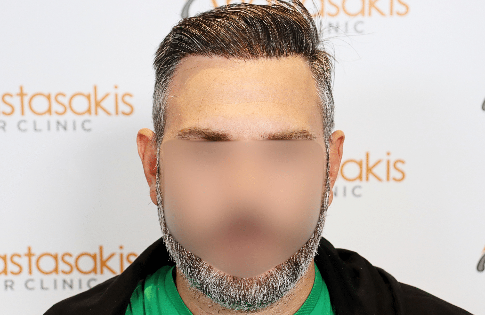 hair transplant result 3500 fus thick 1st stage