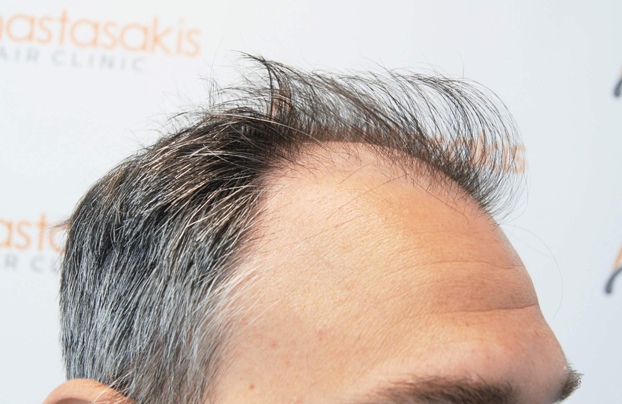 hair transplant result 3500 fus thick 1st stage
