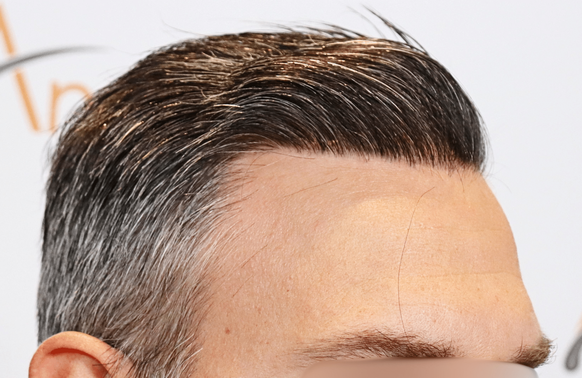 hair transplant result 3500 fus thick 1st stage