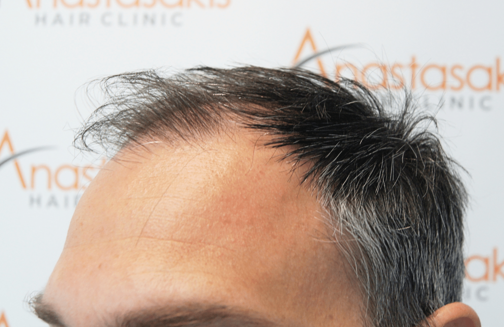 hair transplant result 3500 fus thick 1st stage