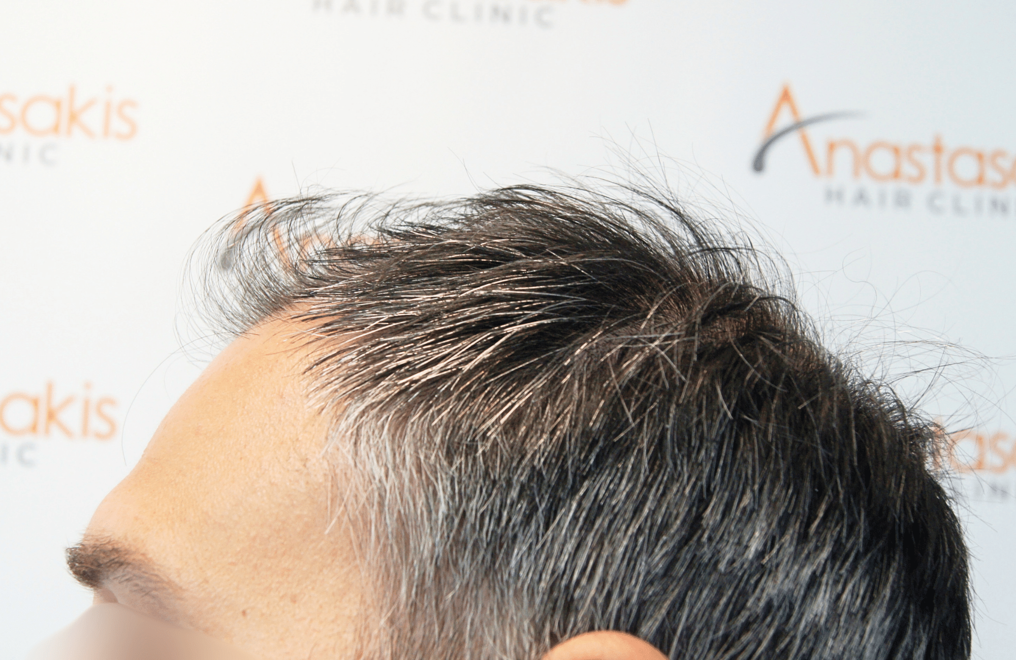 hair transplant result 3500 fus thick 1st stage