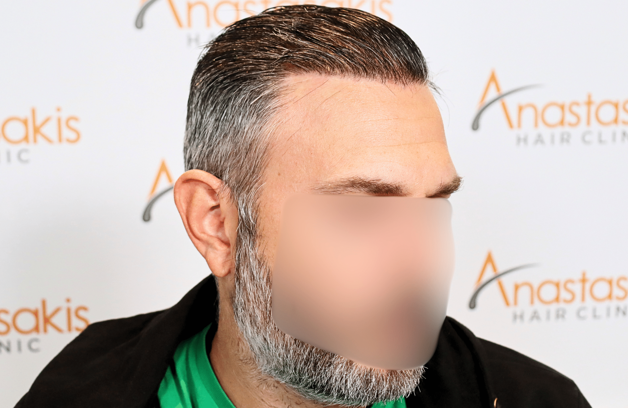 hair transplant result 3500 fus thick 1st stage