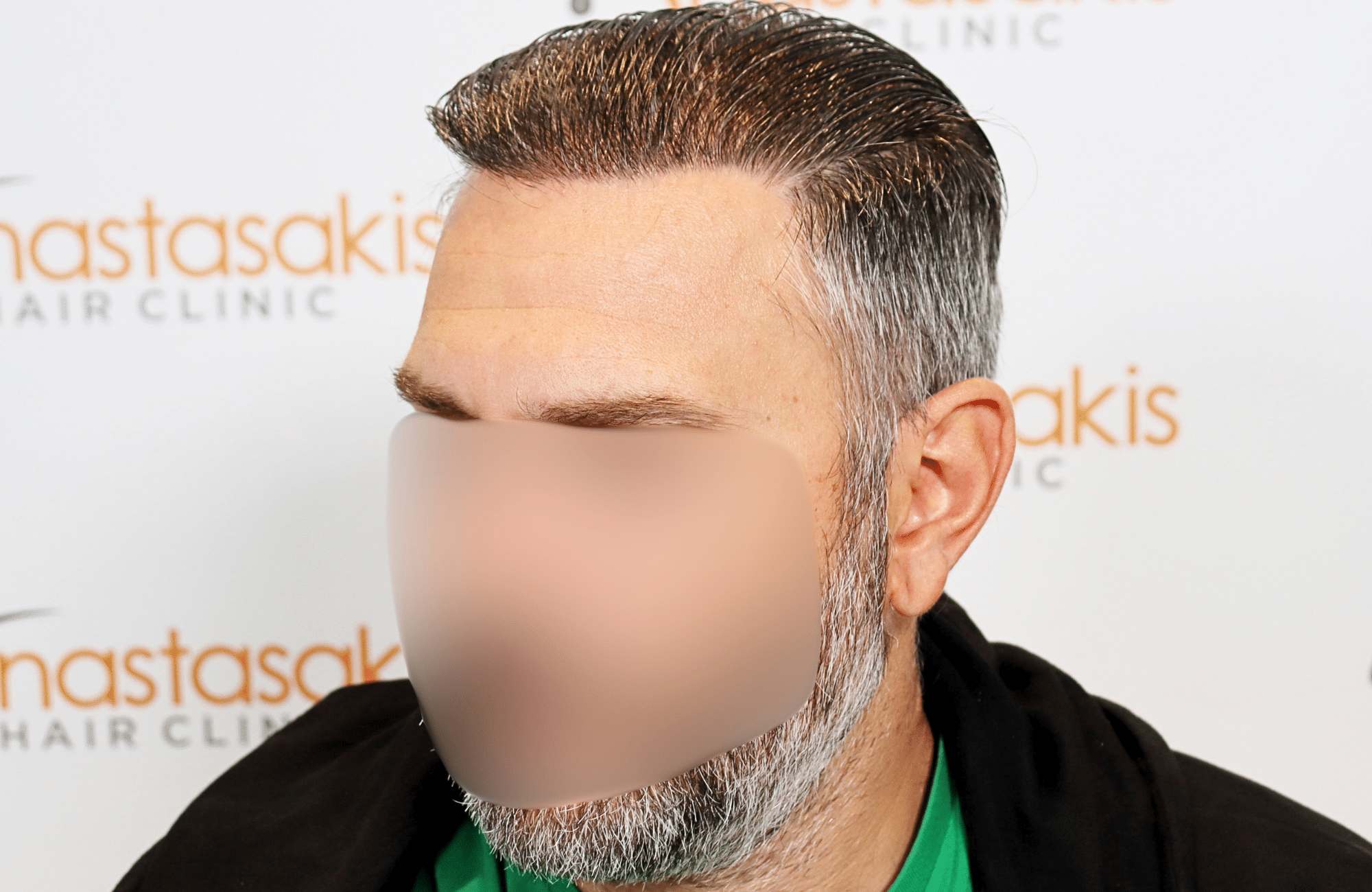 hair transplant result 3500 fus thick 1st stage