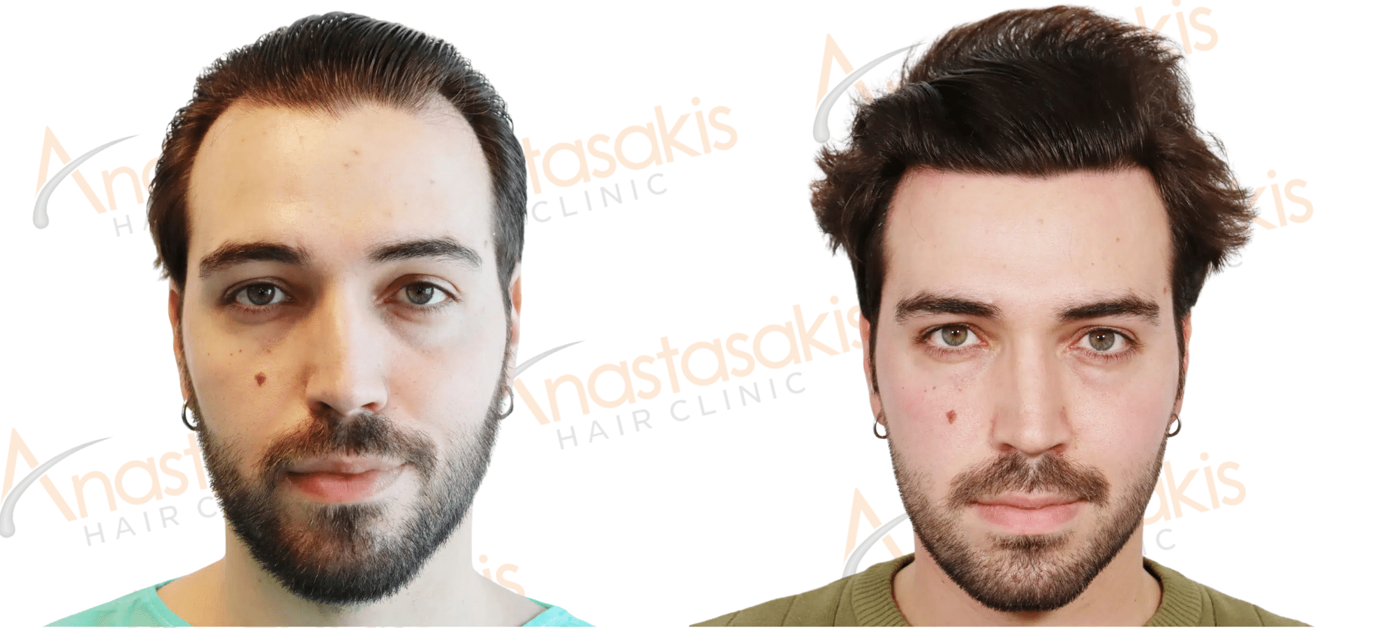 hair transplant result brown thick