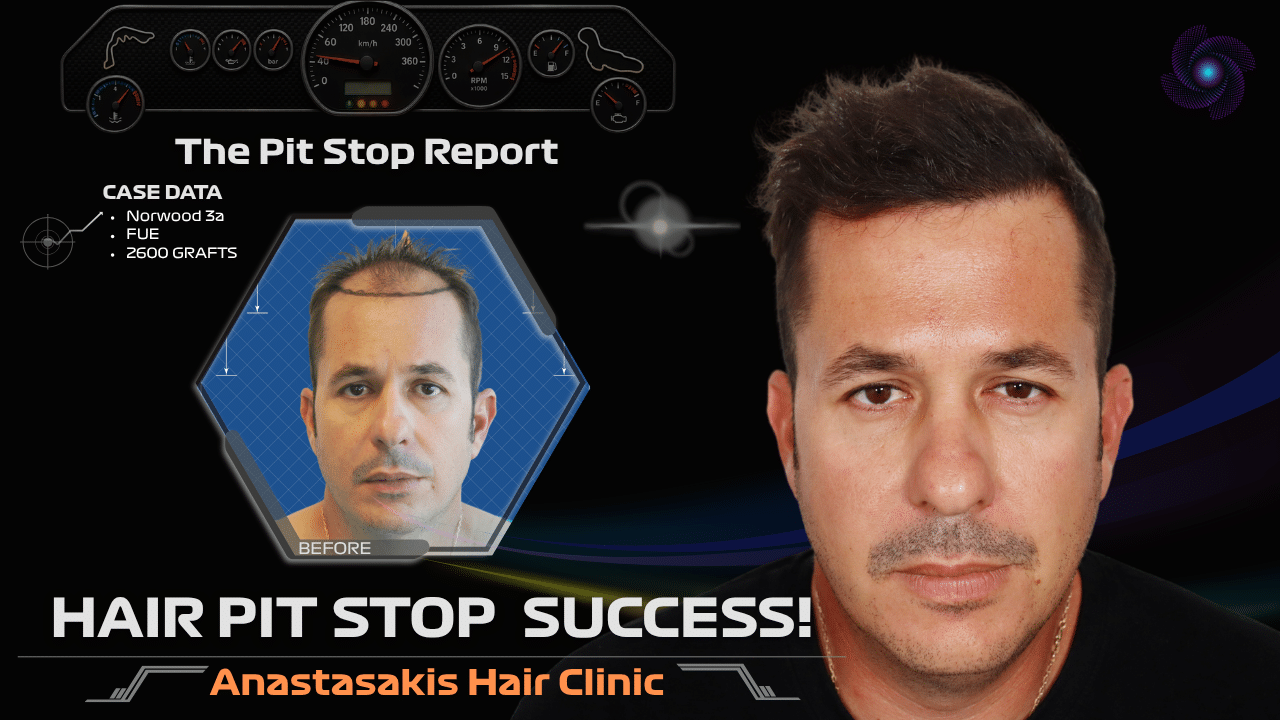 hair transplant result 2600 fus