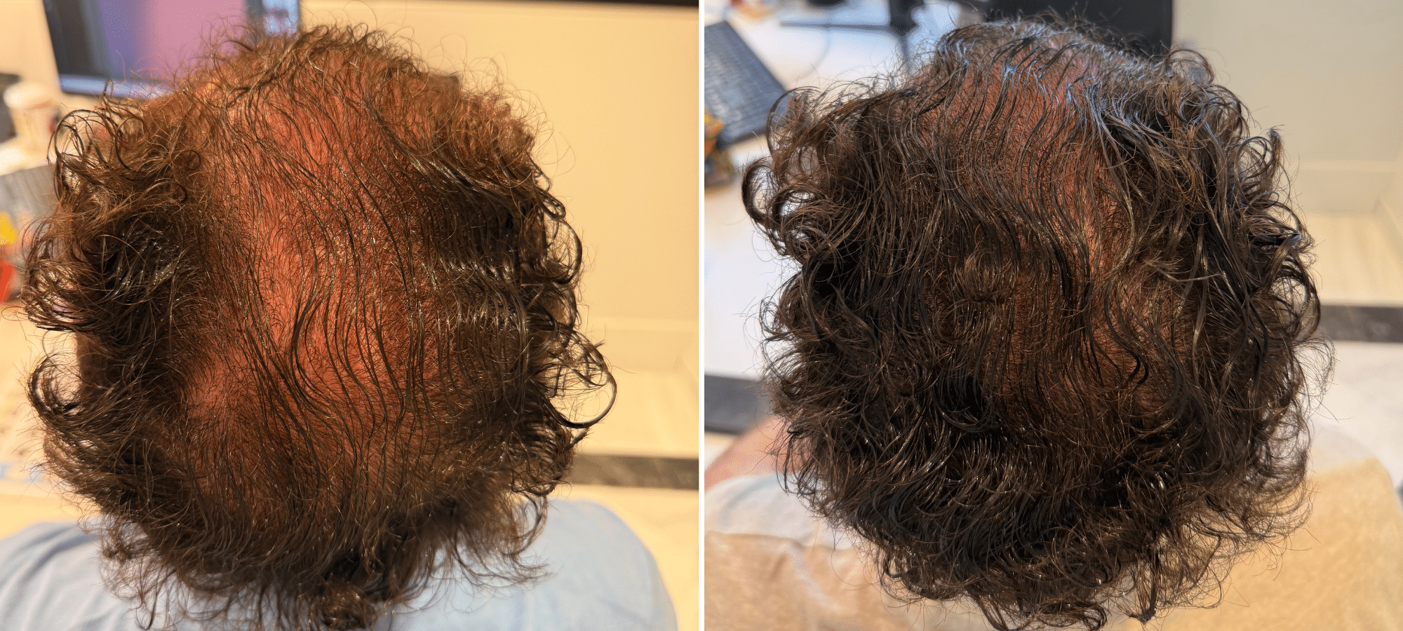Dr. Anastasakis Hair Clinic